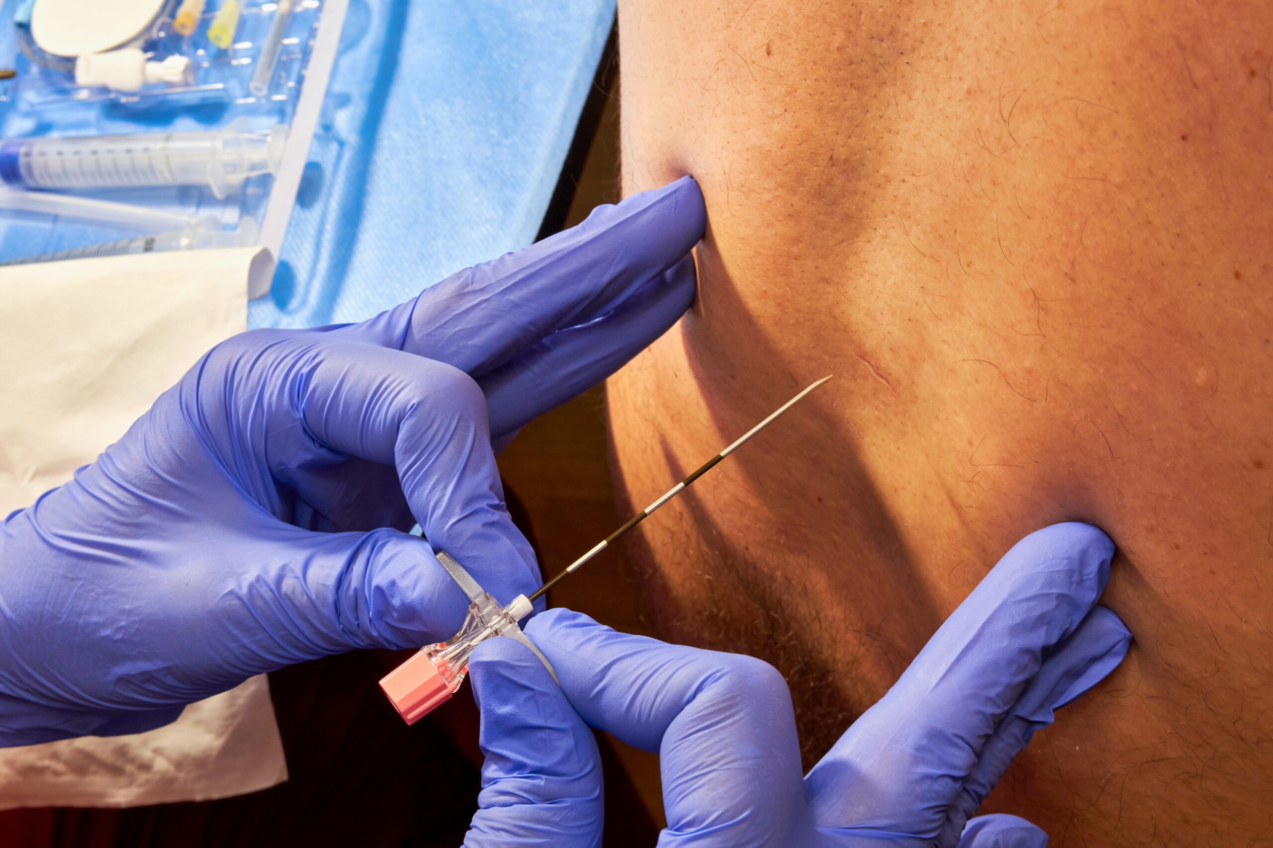 Epidural